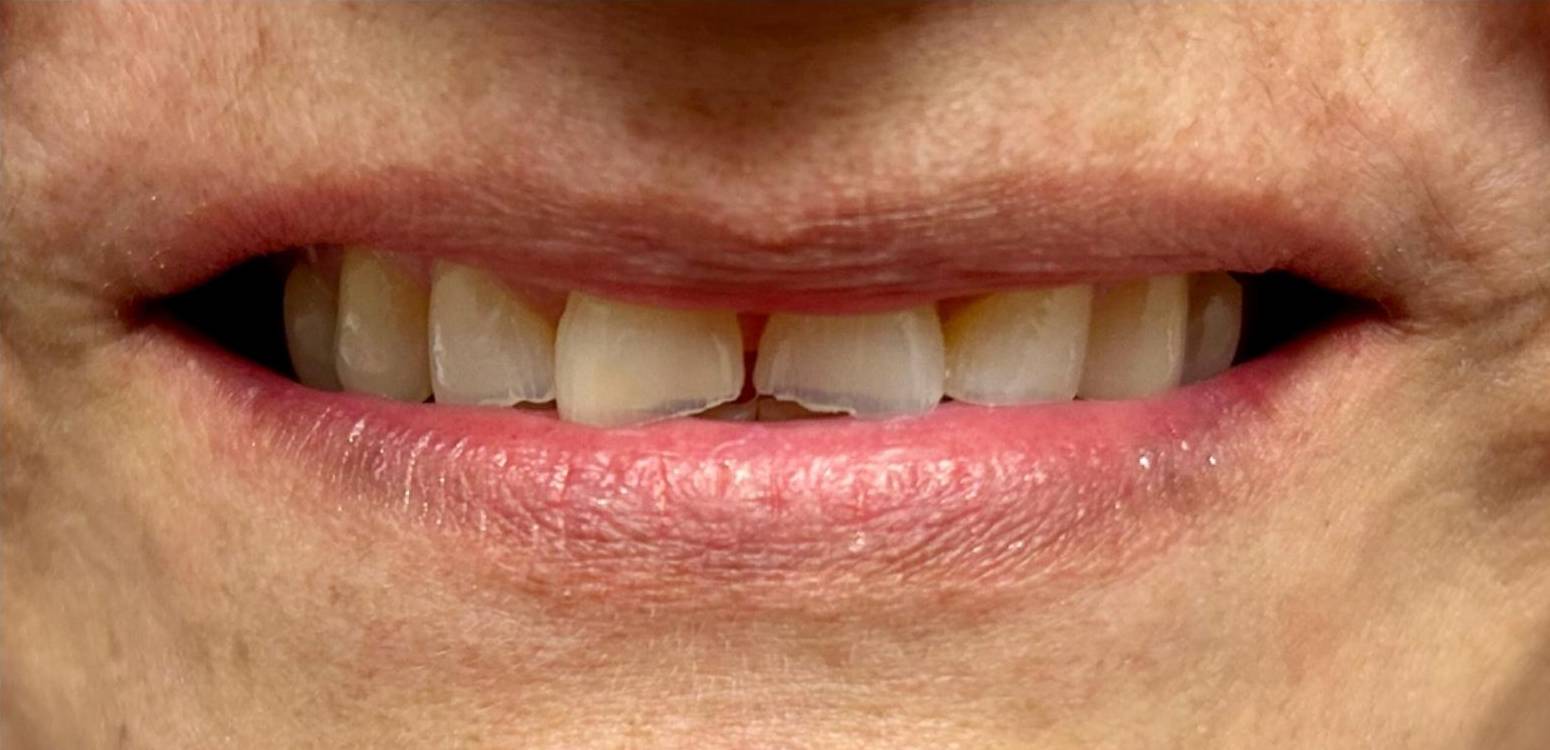 Before dental treatment